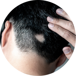 Alopecia areata (spot hair loss)