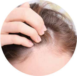 Telogen Effluvium / Diffuse Alopecia