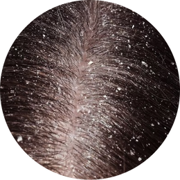 Dry Dandruff (Pityriasis simplex capitis)