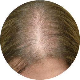 Female Androgenetic Alopecia
