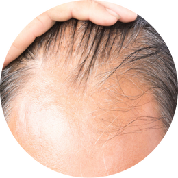 Male Androgenetic Alopecia