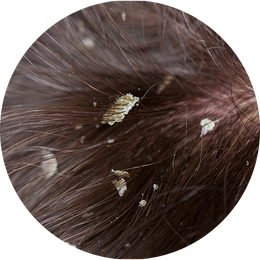 Oily Dandruff (Pityriasis esteatoide)
