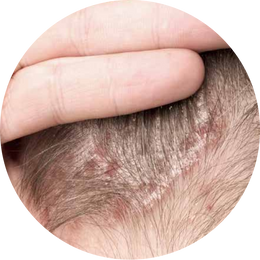 Psoriasis (scalp)