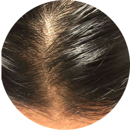 Seborrhea (excess oil / greasy scalp)