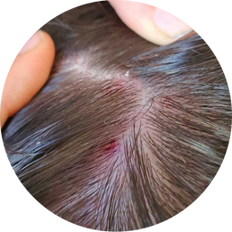 Seborrheic Dermatitis